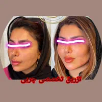 ساکشن غبغب وشکم. کاشت ابرو .|خدمات آرایشگری و زیبایی|پرند, |دیوار