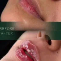 تزریق فیلر.بوتاکس مزوژل نخ توسط شخص پزشک باتجربه