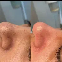 رفع تیرگی نواحی خصوصی