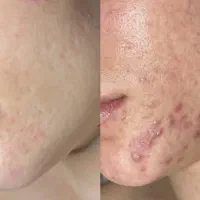 رفع جوش و جای جوش پوست