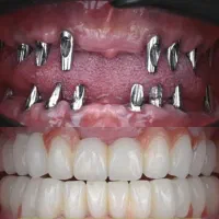 ایمپلنت دیجیتال کرمان