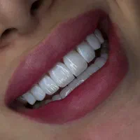 کامپوزیت ، ایمپلنت ، لمینت ، خدمات درمانی اقساطی