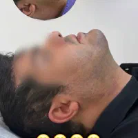 ساکشن غبغب و خدمات زیبایی با شرایط تمام اقساط|خدمات آرایشگری و زیبایی|تهران, شهرک غرب|دیوار