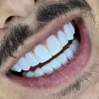 کامپوزیت دندان با چک