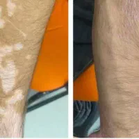 راز درمان پیسی