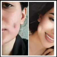 اموزش وخدمات چال گونه وپرسینگ در کلینیک|خدمات آرایشگری و زیبایی|کرمانشاه, |دیوار