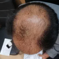 کاشت مو وابرو  باشرایط اقساط