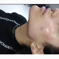 جشنواره باور نکردنی ویژه. ژل و بوتاکس.فیلر مزو ژل|خدمات آرایشگری و زیبایی|شیراز, سینما سعدی|دیوار
