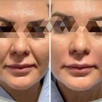 تزریق ژل لب و گونه و چانه.. (جشنواره)درمطب فقط499ت|خدمات آرایشگری و زیبایی|اصفهان, باغ زیار|دیوار