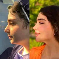 جراحی بینی ۴۵/لیپو ابدو /پروتز سینه صد درصد تضمینی