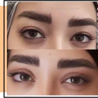 بلفاروپلاستی جراحی عمل پلک (بخیه لیزری)و کاشت مو