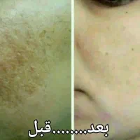 کرم سفیدکننده و ضدلک تصمینی