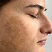 خدمات حرفه ای تخصصی،لک کک مک موی زائدسفیدالکترولیز|خدمات آرایشگری و زیبایی|قم, صفائیه|دیوار