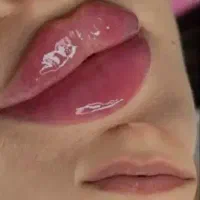 ژل و بوتاکس زیر نظر پزشک آف %20