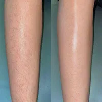 لیزر موی زاید،هایفو فشیال،فیلر مزو  در مطب آلالیزر|خدمات آرایشگری و زیبایی|کرج, حسین‌آباد|دیوار