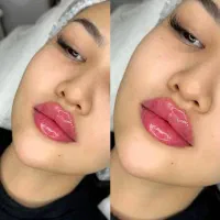 جشنواره تخفیفات ژل بوتاکس دکترکاظمی