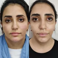 تزریق ژللب ،گونه،زاویه فک و چانه و بوتاکس،مادلینگ|خدمات آرایشگری و زیبایی|اصفهان, رکن الدوله شرقی|دیوار