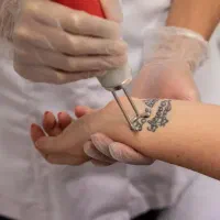 پاک‌کردن وریمو تتو بدن و ابرو بالیزر کیوسویئچ