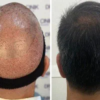 آموزش کاشت مو و ابرو همراه با معرفی به کار