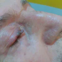 ختنه ،جراحی سرپایی وزیبایی