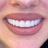 دندانپزشکی ، ونیر کامپوزیت و لمینت با شرایط پرداخت