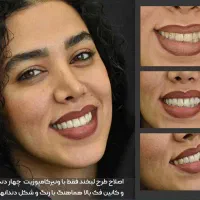 کامپازیت دندان ونیر لمینت عصب کشی جراحی