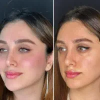 ژل لب بوتاکس فیلر مزو ژل یانگ فیس پی ارپی نخ لیفت|خدمات آرایشگری و زیبایی|مشهد, احمدآباد|دیوار