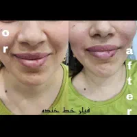 بمب تخفیف ژل و بوتاکس|خدمات آرایشگری و زیبایی|بندر امام خمینی, |دیوار