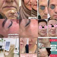 تنها مرکز هایفو 12بعدی )اراف ویژه(گلدایستاده|خدمات آرایشگری و زیبایی|اهواز, زیتون کارمندی|دیوار