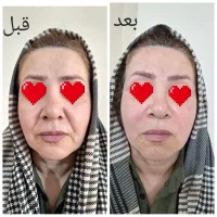 بوتاکس ژل نخ چالگونه مزو انزیم فیلر|خدمات آرایشگری و زیبایی|تبریز, |دیوار