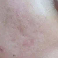 درمان تخصصی در یک جلسه اسکار آکنه و جای جوش|خدمات زیبایی و سلامت|کرمانشاه, |دیوار