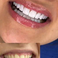 کامپوزیت دندان|خدمات آرایشگری و زیبایی|فولادشهر, B2|دیوار