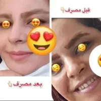 کرم کره ای اصل ضدلک و جوش و رفع تیرگی|آرایشی، بهداشتی، درمانی|بندر ترکمن, |دیوار