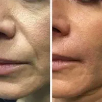 کرم ضدچروک و کلاژن ساز جایگزین بوتاکس(ضمانت اصل)|آرایشی، بهداشتی، درمانی|تهران, درب دوم|دیوار