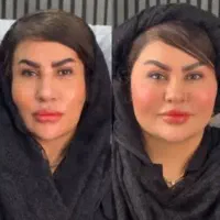 مرکز تخصصی جوانسازی فقط در ۱ جلسه/هایفو/لیفت ۸۹۰ت|خدمات آرایشگری و زیبایی|اصفهان, سودان|دیوار