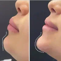 تزریق ژل/فیلر فقط تا پنجشنبه(جشنواره)درمطب فقط499ت|خدمات آرایشگری و زیبایی|اصفهان, باغ زیار|دیوار