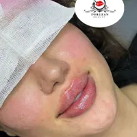 آفر(۷ روزه) ژل و بوتاکس فولادشهر|خدمات آرایشگری و زیبایی|فولادشهر, فولادشهر|دیوار