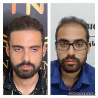 کاشت مو و ابرو با ضمانتنامه کتبی با ۸ ملیون تومان|خدمات آرایشگری و زیبایی|تهران, پاسداران|دیوار