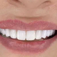 تخفیف ۵۰درصدی ایمپلنت کره ای دندان فقط ۱۱میلیون