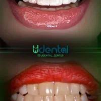 کامپوزیت، لمینت، ایمپلنت اقساط ویژه|خدمات آرایشگری و زیبایی|تاکستان, |دیوار