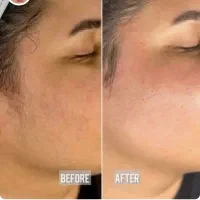 درما صورت (پاک سازی و اصلاح )