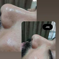 پاکسازی کامل صورت|خدمات آرایشگری و زیبایی|مشهد, یوسفیه|دیوار
