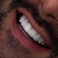 کامپوزیت/اقساط بدون پیش پرداخت