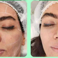 تزریق ژل بوتاکس فیلر چشم هایفو مزو جوانساز زاویه|خدمات آرایشگری و زیبایی|تهران, هفت حوض|دیوار