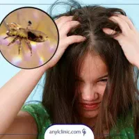 ا محلول ضد شپش