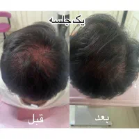 پی ار پی980/فیلر مانجارو/مزوتراپی/بوتاکس حجامت فصد