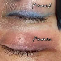 پاک کردن و ریموو تتو ابرو چشم لب ۱۰۰٪ تضمینی|خدمات آرایشگری و زیبایی|یاسوج, |دیوار