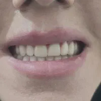 دندانسازی (دندان مصنوعی)|آرایشی، بهداشتی، درمانی|تبریز, |دیوار