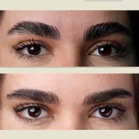 بوتاکس چشم گربه ای و چشم روباهی