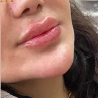 تزریق و آموزش بوتاکس و ژل و پرسینگ و مزو و غیره|خدمات آرایشگری و زیبایی|شیراز, نصر|دیوار